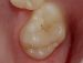 molar tooth