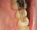 occlusal