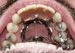 partial denture