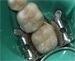 perm molars